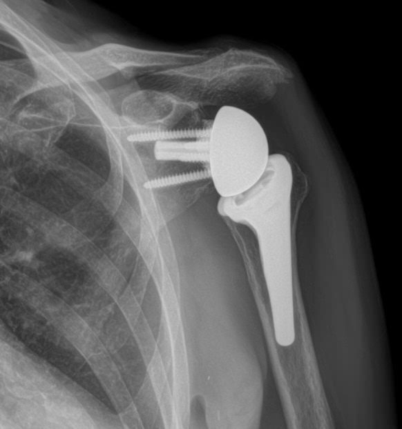 Reverse shoulder arthroplasty