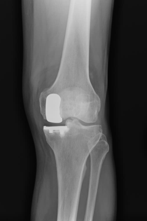 Partial Knee Replacement