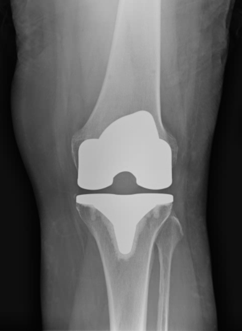 Total Knee Replacement