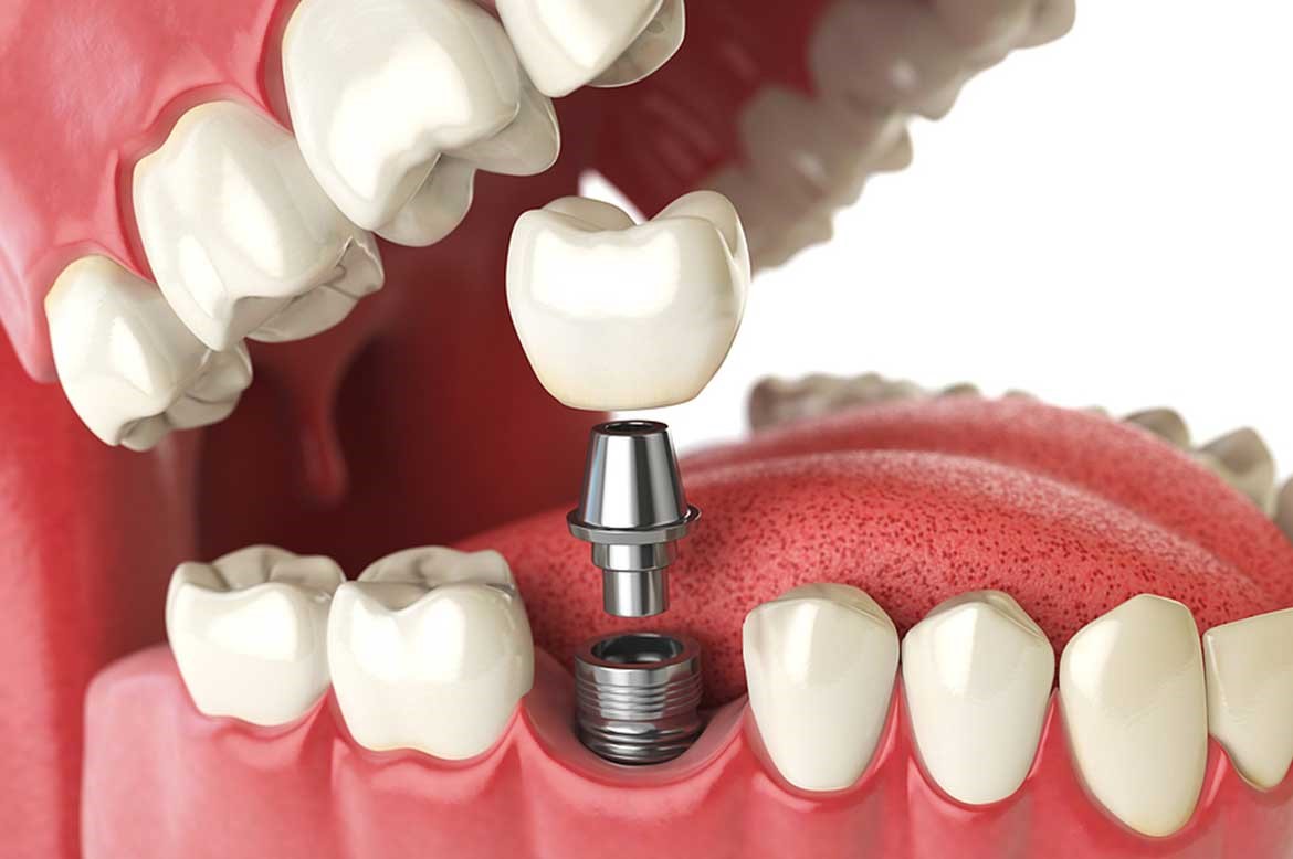 Home Care After Dental Implants