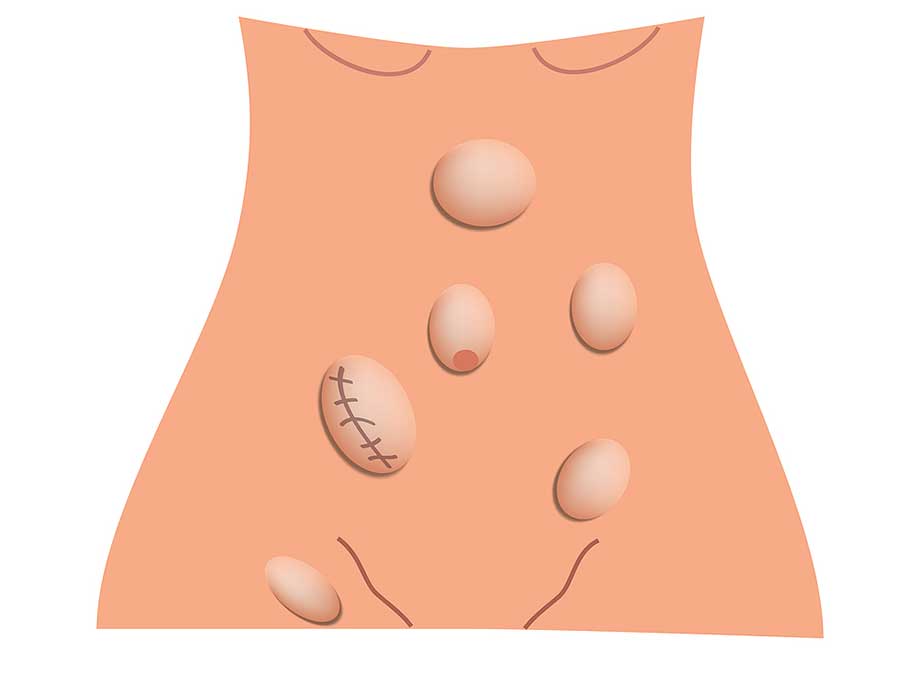 Groin/Inguinal