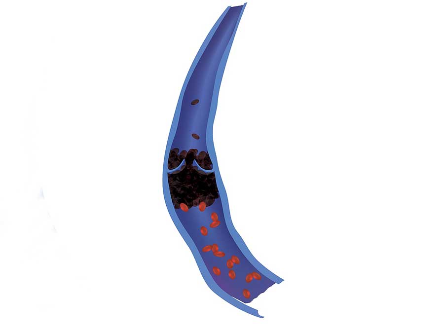 Venous (DVT)